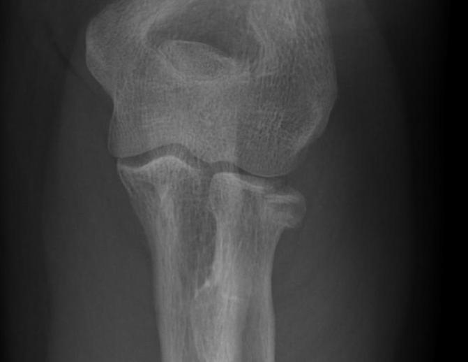 Radial Head Fracture Mason 1